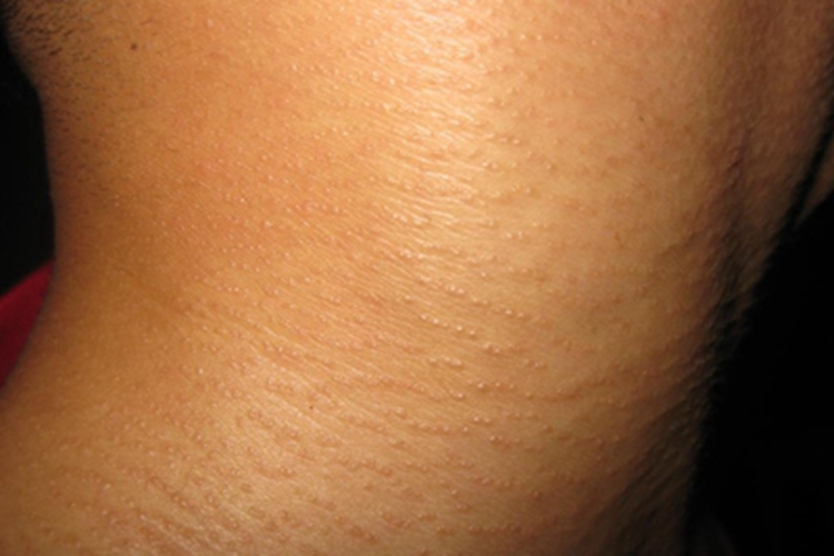 汗管瘤侧颈症状图