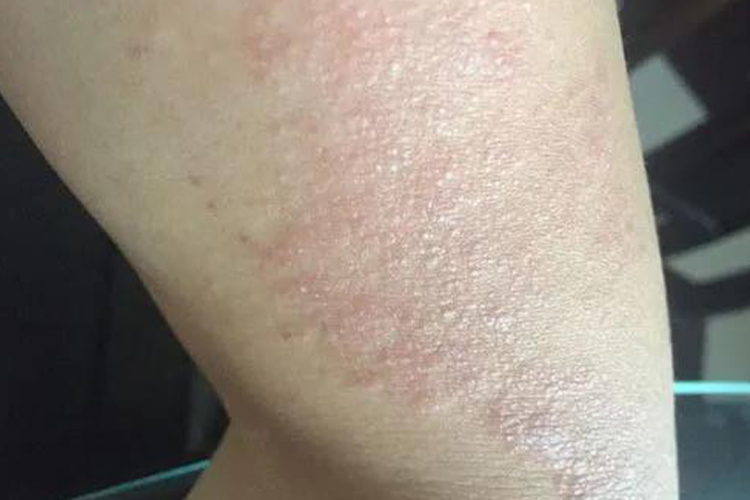 紫外线过敏腿部小红点图