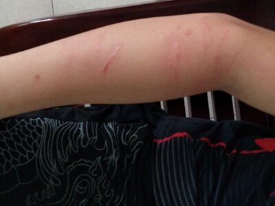 抓伤后胳膊上有抓痕有轻微出血图.jpg