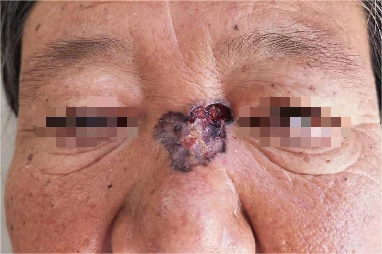 表浅型基底细胞癌图