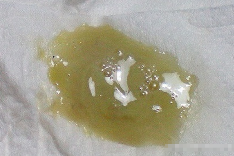 滴虫性阴道炎深黄色分泌物图 滴虫性阴道炎深黄色分泌物图