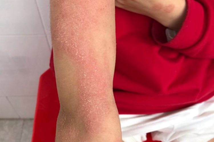 特应性皮炎胳膊脱皮图