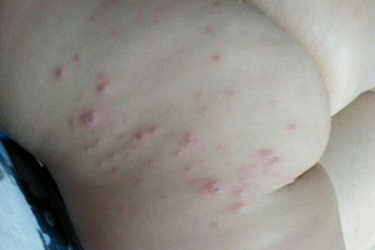 手足口病臀部症状图 手足口病臀部症状图