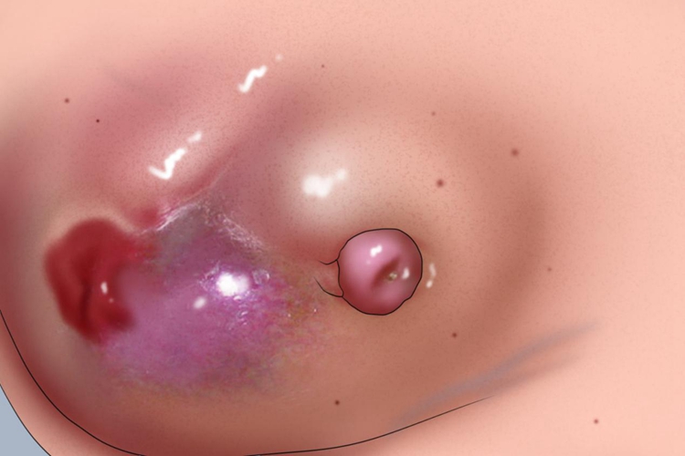 非哺乳期乳腺炎化脓症状图