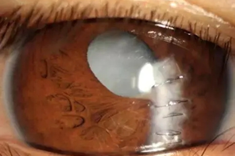 眼球穿孔伤所致白内障症状图