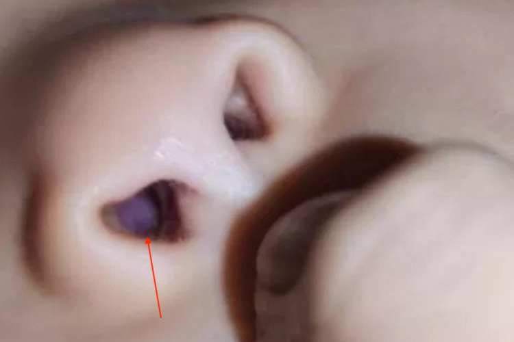 新生儿下鼻甲肥大图