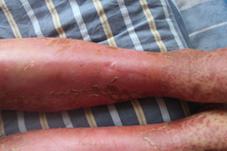 红皮病型银屑病小腿红肿图