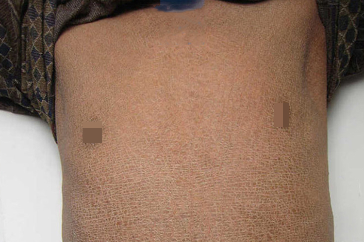 获得性鱼鳞病胸部脱屑图
