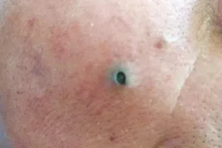 扩张孔面部小孔图