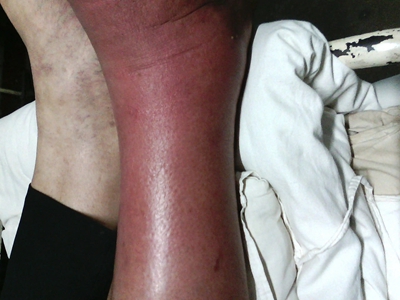 急性期皮肤丝虫病腿部红肿发亮图