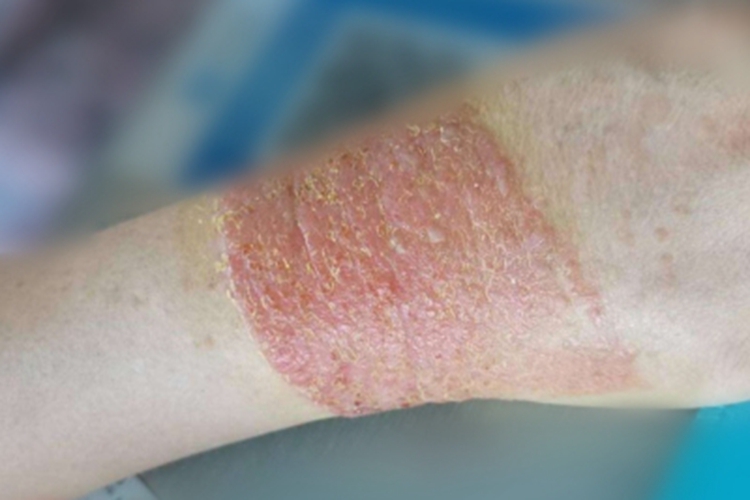 变应性接触性皮炎手腕红肿图片