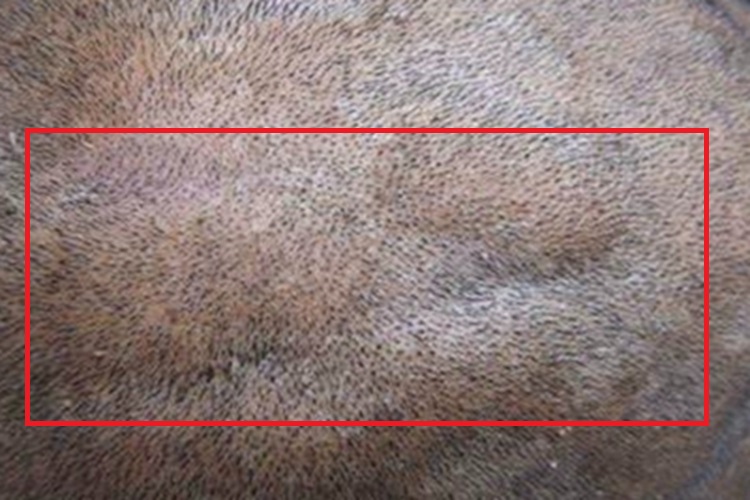 回状颅皮头皮纹图 回状颅皮头皮纹图