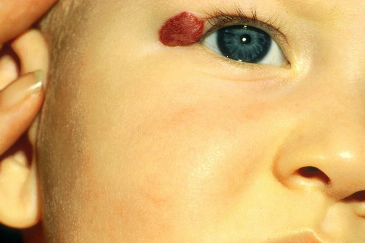 蔓状血管瘤眼角症状图 蔓状血管瘤眼角症状图