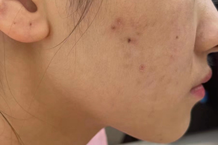 痤疮脸上有结痂图