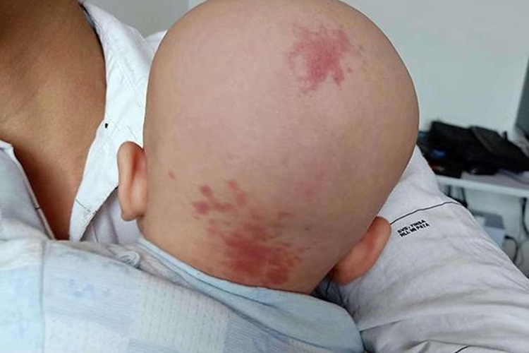 橙红色斑红色胎记图 橙红色斑红色胎记图