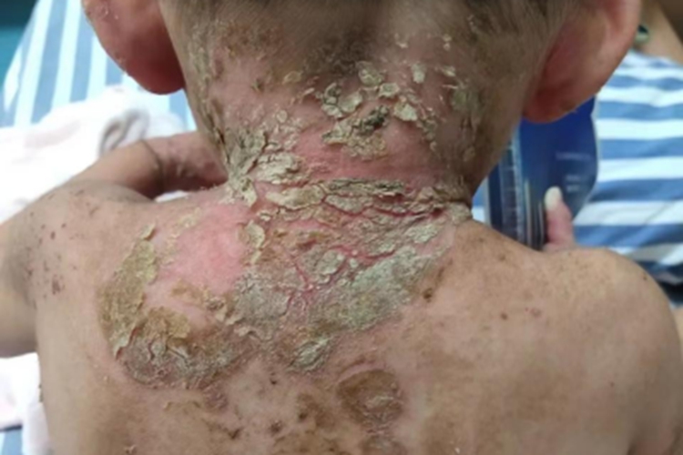 脓疱病后颈糜烂结痂图