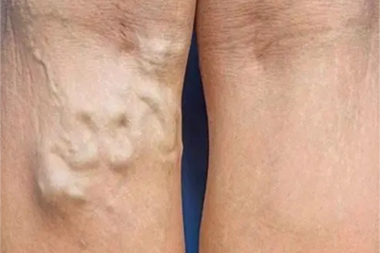 游走性血栓性静脉炎腘窝症状图