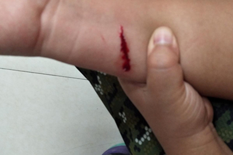 划伤胳膊出血图