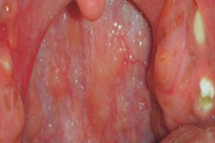 慢性扁桃体炎咽喉脓肿图