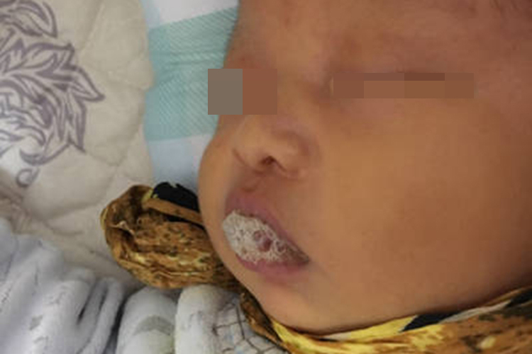 新生儿肺炎口周发青图 新生儿肺炎口周发青图