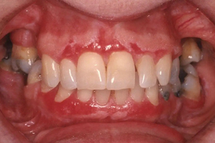 过敏性接触性口炎牙龈症状图 过敏性接触性口炎牙龈症状图