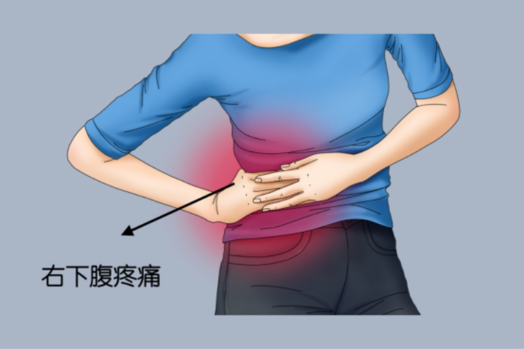 女性右下腹疼痛图