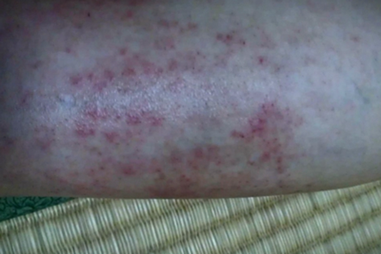 皮肤过敏红肿小腿小红疙瘩图