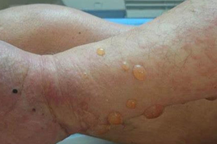 红斑型天疱疮小腿水疱图 红斑型天疱疮小腿水疱图