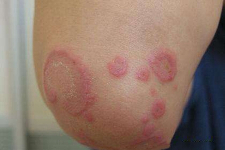 寒冷性多形红斑肘部红斑图 寒冷性多形红斑肘部红斑图