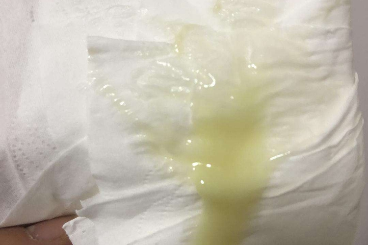 淋菌性前庭大腺炎脓性分泌物图