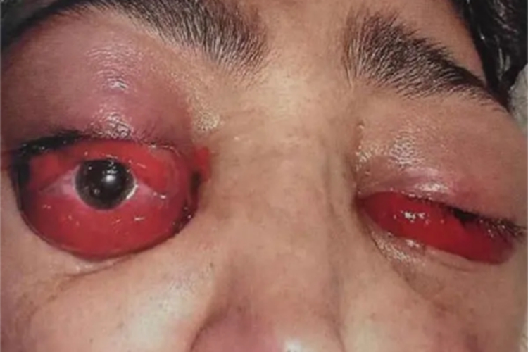 甲状腺相关眼病眼球症状图