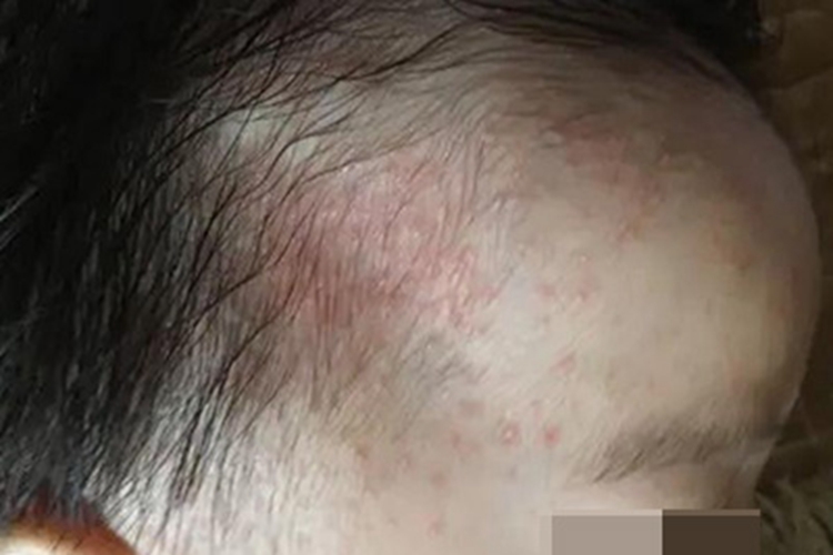 急性湿疹前额疙瘩图