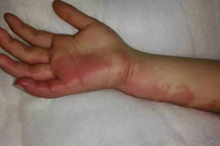 血管型胎记手掌红斑图