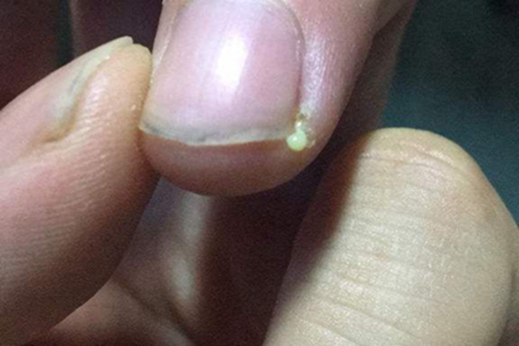 甲床炎手指渗脓液图