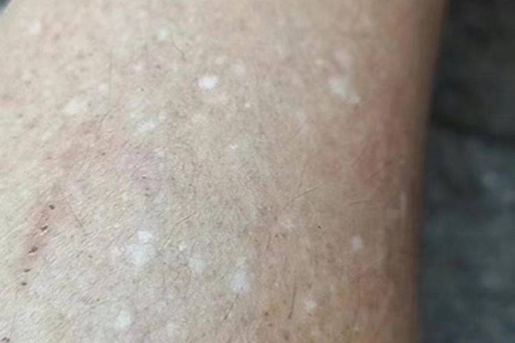 老年性点状白斑腿部白斑图
