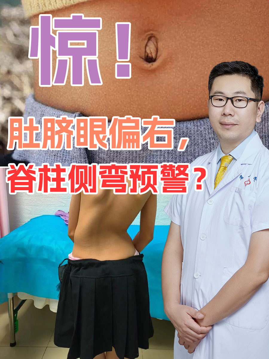 惊！肚脐眼偏右，脊柱侧弯预警？