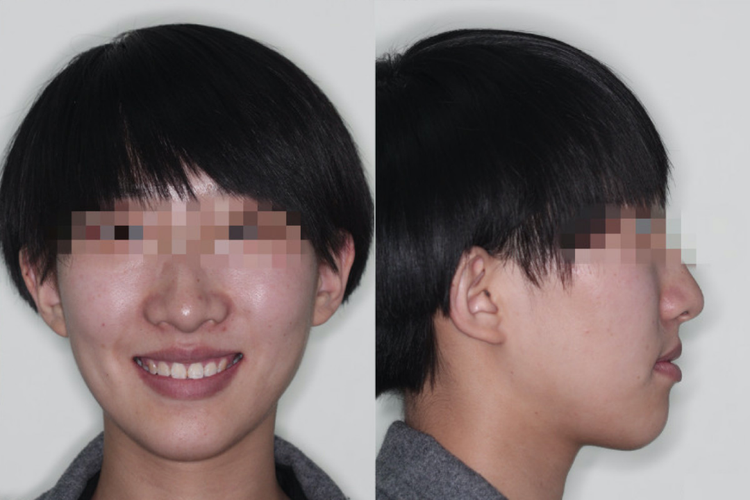 严重龅牙矫正后图片