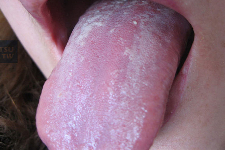 口腔念球菌早期图片 口腔念球菌早期图片