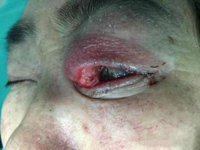 角膜鳞状上皮细胞癌的症状和图片 - 有来医生