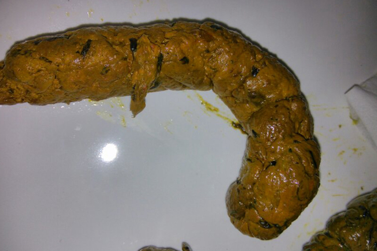 肝癌正常大便图