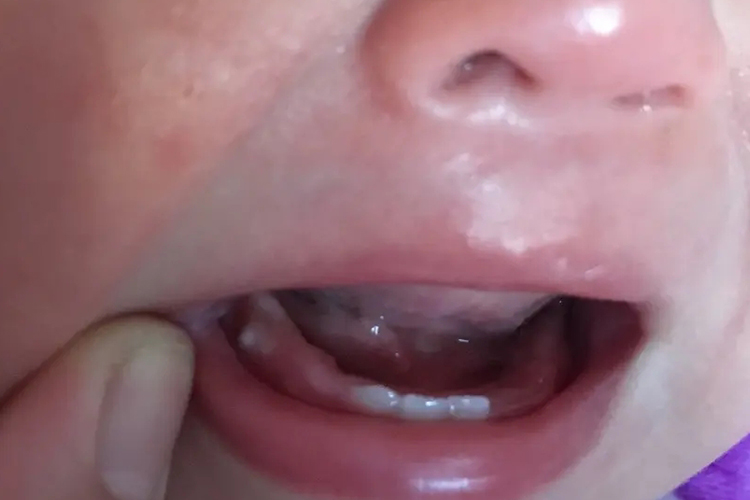 婴儿后槽牙发白马牙图