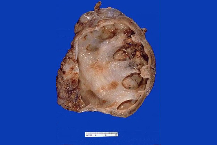 肾压迫性萎缩标本图