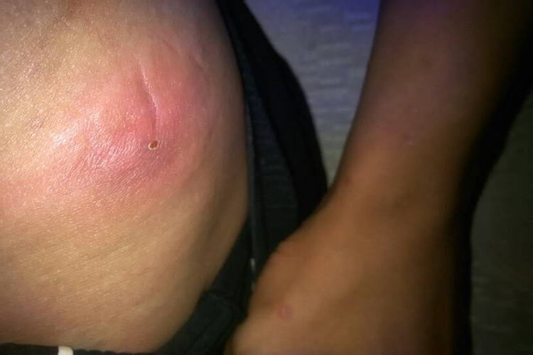 腰大肌浅表脓肿图