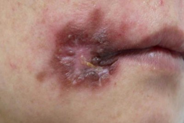 颌面部获得性梅毒口周症状图 颌面部获得性梅毒口周症状图