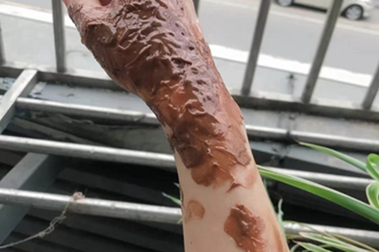 二度烫伤手上脱皮图