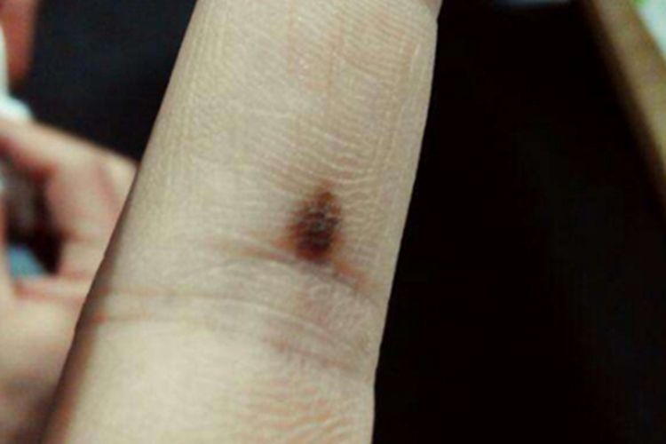 浅表播散型黑色素瘤手指黑斑图 浅表播散型黑色素瘤手指黑斑图