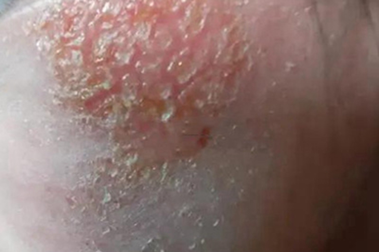 急性湿疹面部红斑渗液脱屑图 急性湿疹面部红斑渗液脱屑图