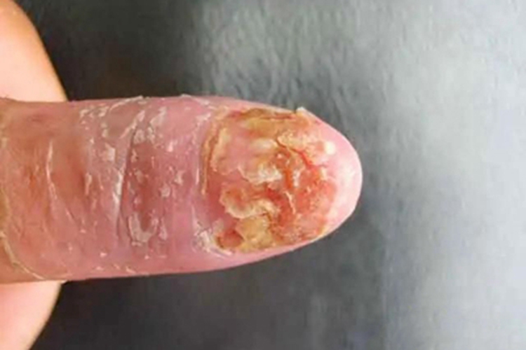肠病性肢端皮炎手指甲萎缩脱皮图 肠病性肢端皮炎手指甲萎缩脱皮图