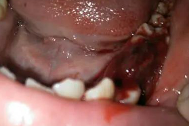 血管性血友病拔牙后出血不止图