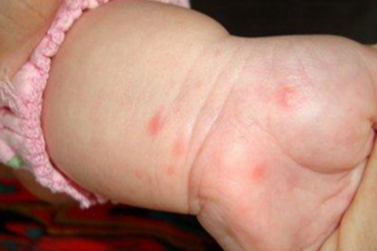手足口病手腕上长小红疙瘩图